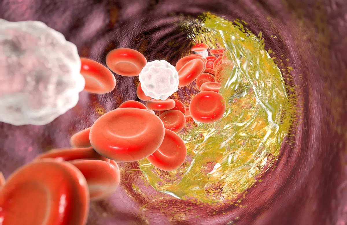 Biểu đồ minh họa sự giảm cholesterol xấu (LDL) khi sử dụng nước gạo lứt rang, tốt cho tim mạch