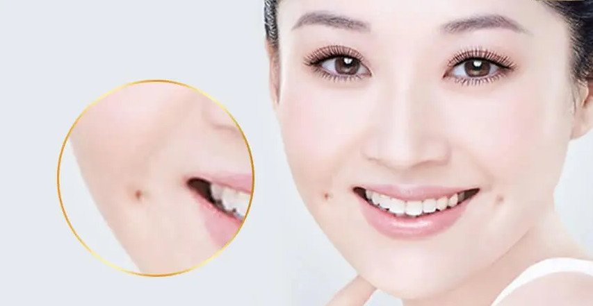 Chi phí thực hiện má lúm phụ thuộc vào nhiều yếu tố