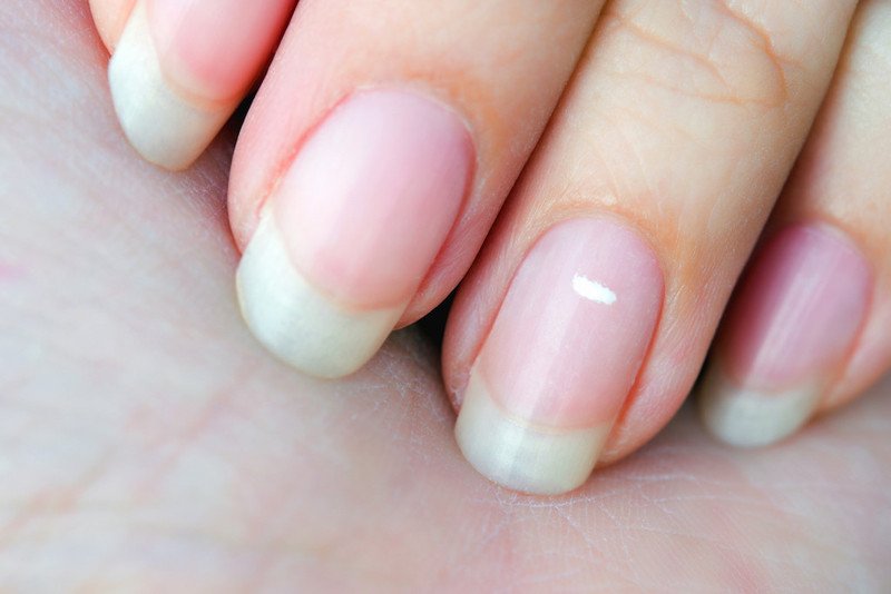 Một ngón tay bị chấn thương nhẹ với những hạt gạo trên móng tay, minh họa nguyên nhân tổn thương vật lý.
