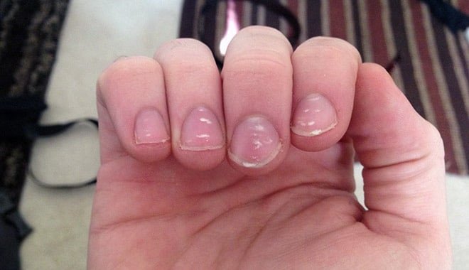 Đốm trắng li ti trên móng tay, còn gọi là hạt gạo trên móng