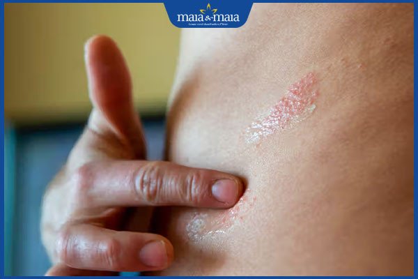 Dưỡng ẩm cho da viêm da cơ địa bằng dầu cám gạo