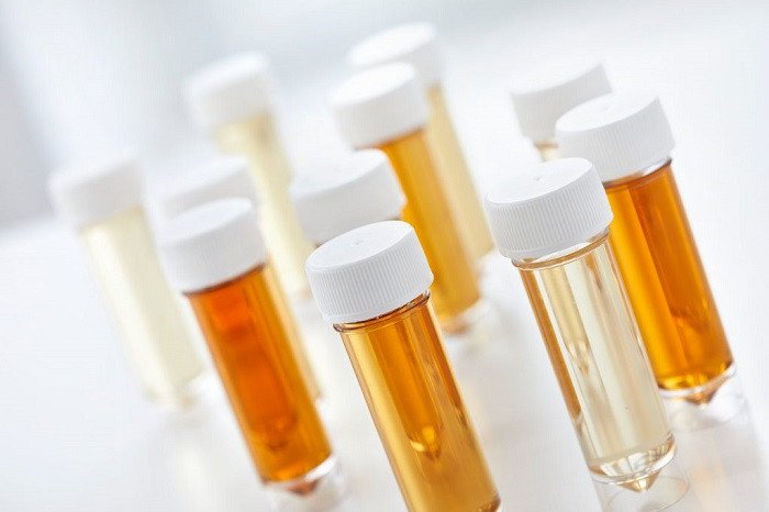 Màu nước tiểu trắng đục như nước gạo cảnh báo vấn đề sức khỏe nữ giới