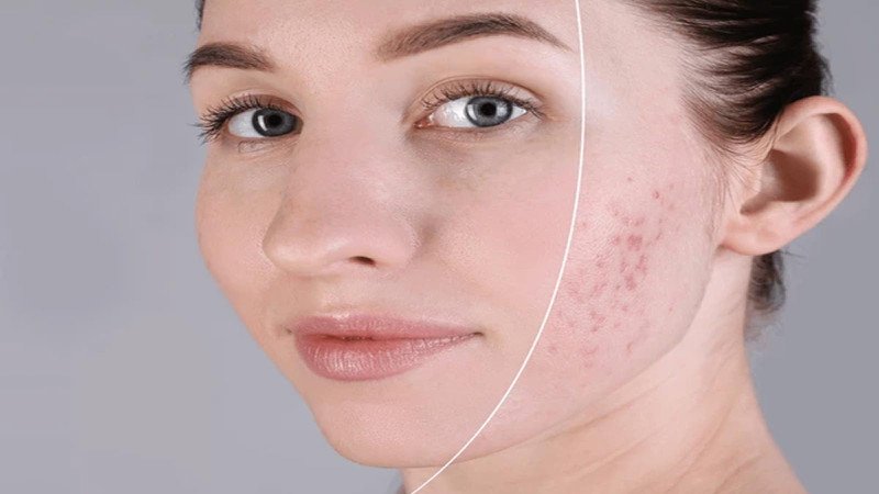 Rửa mặt bằng nước vo gạo đúng cách sẽ giúp điều trị mụn