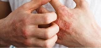 Sự lây lan của hạt cơm lòng bàn tay qua tiếp xúc da bị tổn thương, minh họa nguy cơ khi lòng bàn tay nổi hạt gạo.